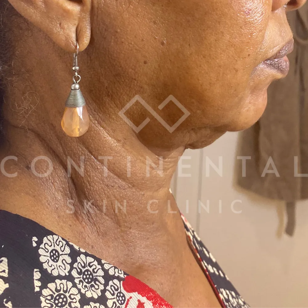 Infini RF Texture Smoothing London