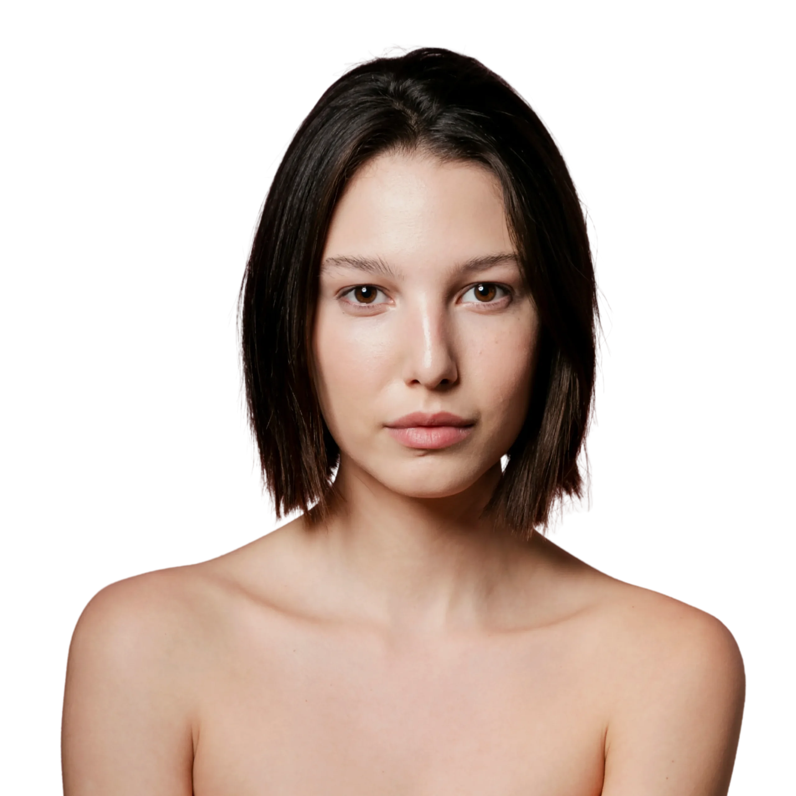 Before and after Radiesse treatment results showing improved skin firmness and lift