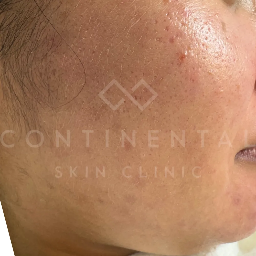 Instant Facial Brightening with Hollywood Spectra Laser