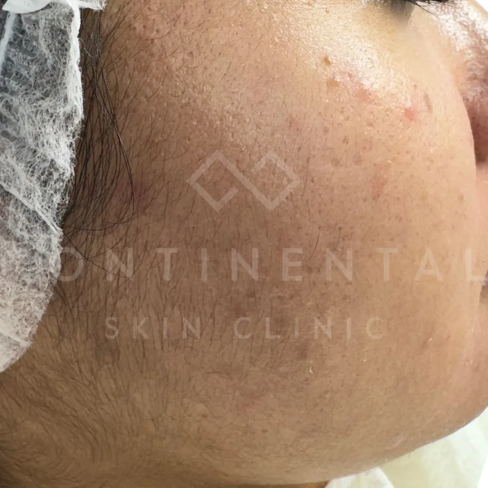 Real results with Laser Hair Bleaching London — darker facial fluff becomes invisible, leaving a clearer and more luminous finish.