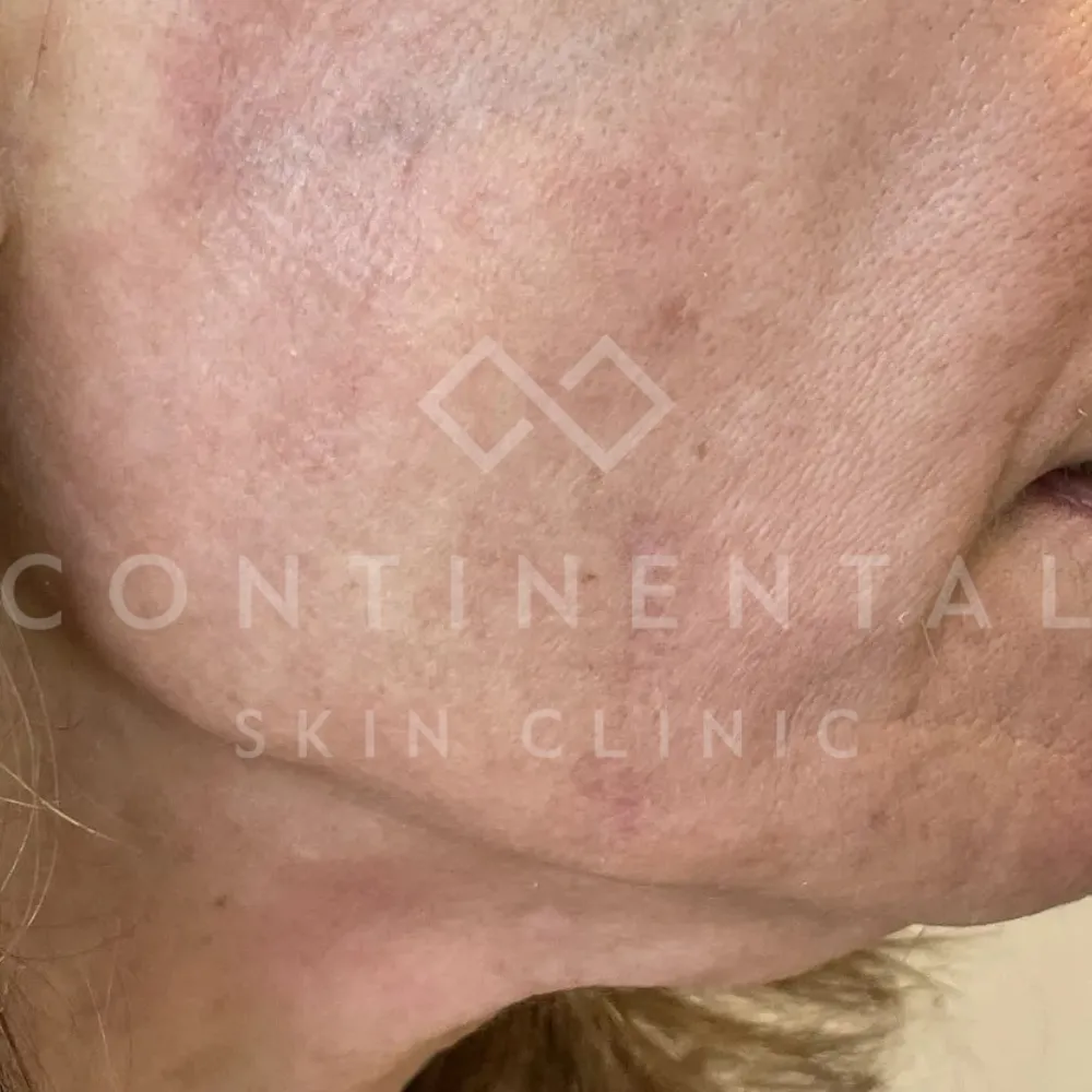 Healite II After Continental Skin Clinic Wound Healing Scar London (1)