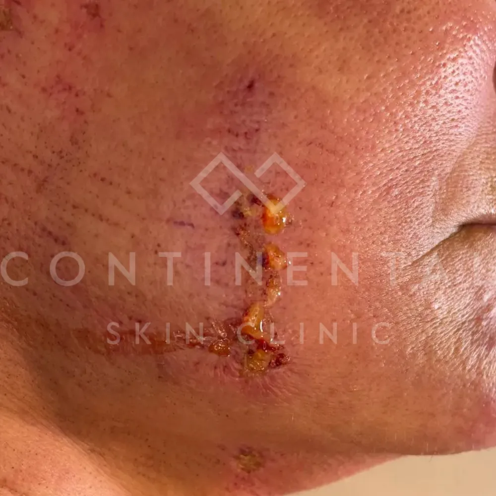 Healite II Before Continental Skin Clinic Wound Healing Scar London (1)