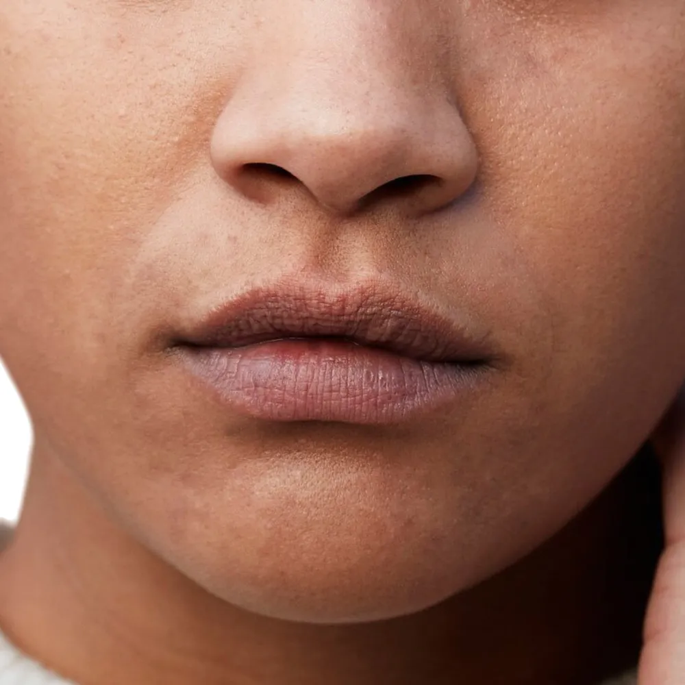 Freckles and pigmented spots on the lips before laser pigmentation treatment.