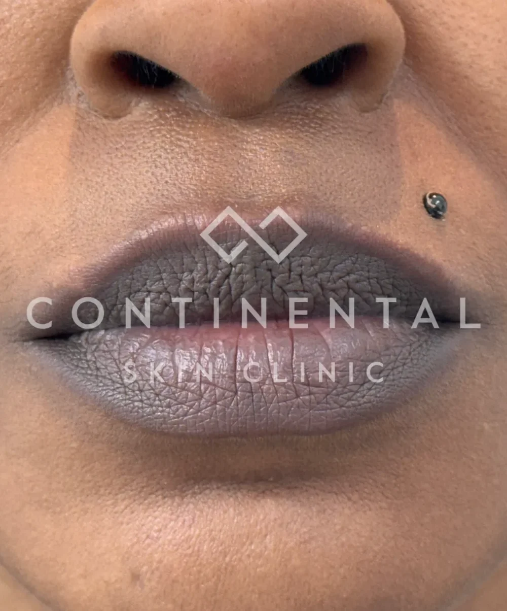 Dark corners of the mouth and perioral pigmentation treated in London.
