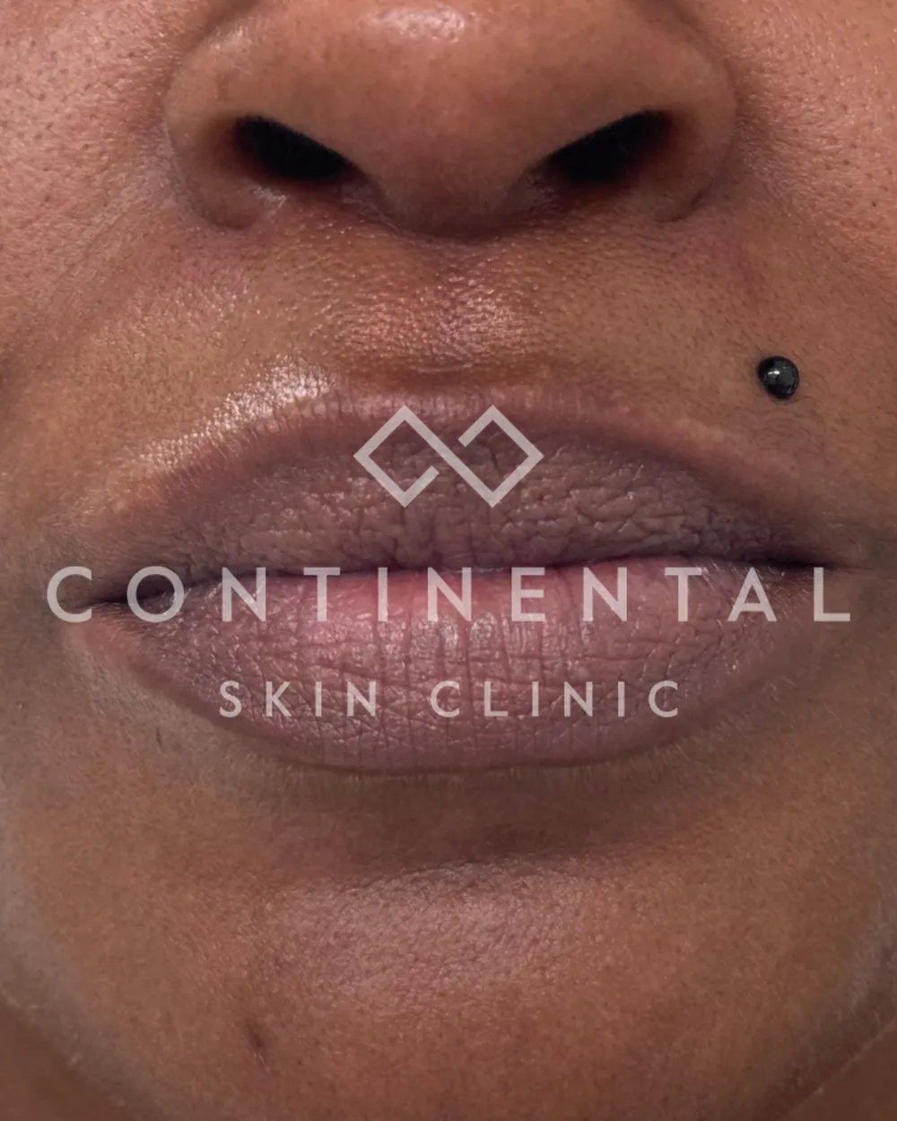 Two-tone lips with darker borders before laser lip pigmentation removal.