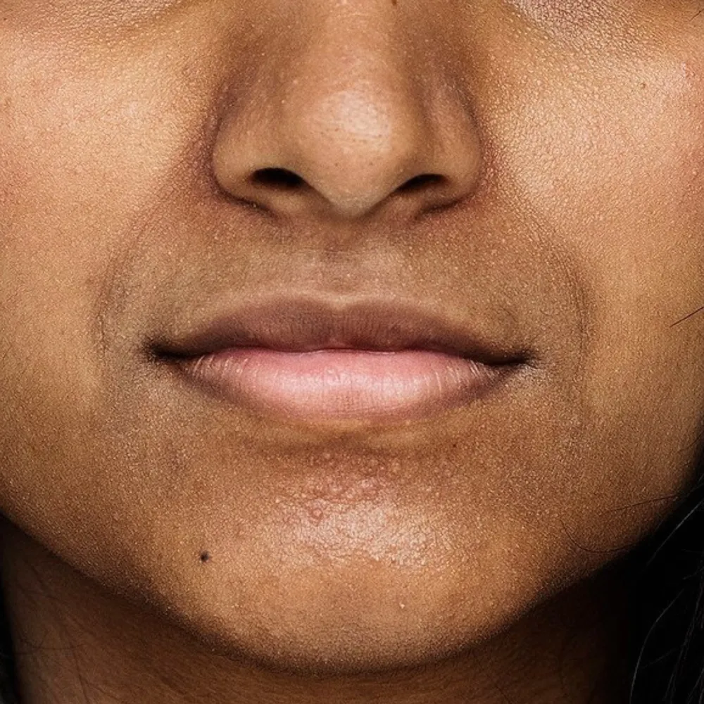 Dark corners of the mouth and perioral pigmentation treated in London.