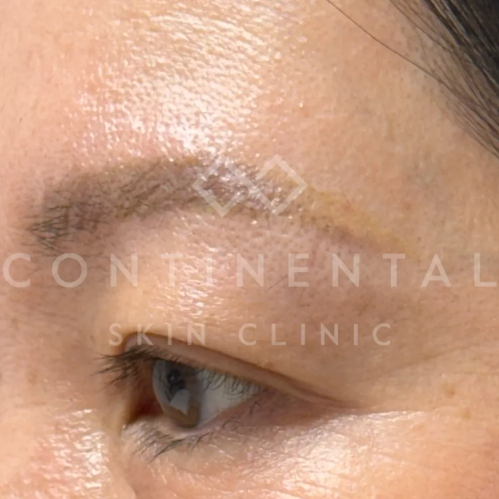 eyebrow hair growth after tattoo removal london