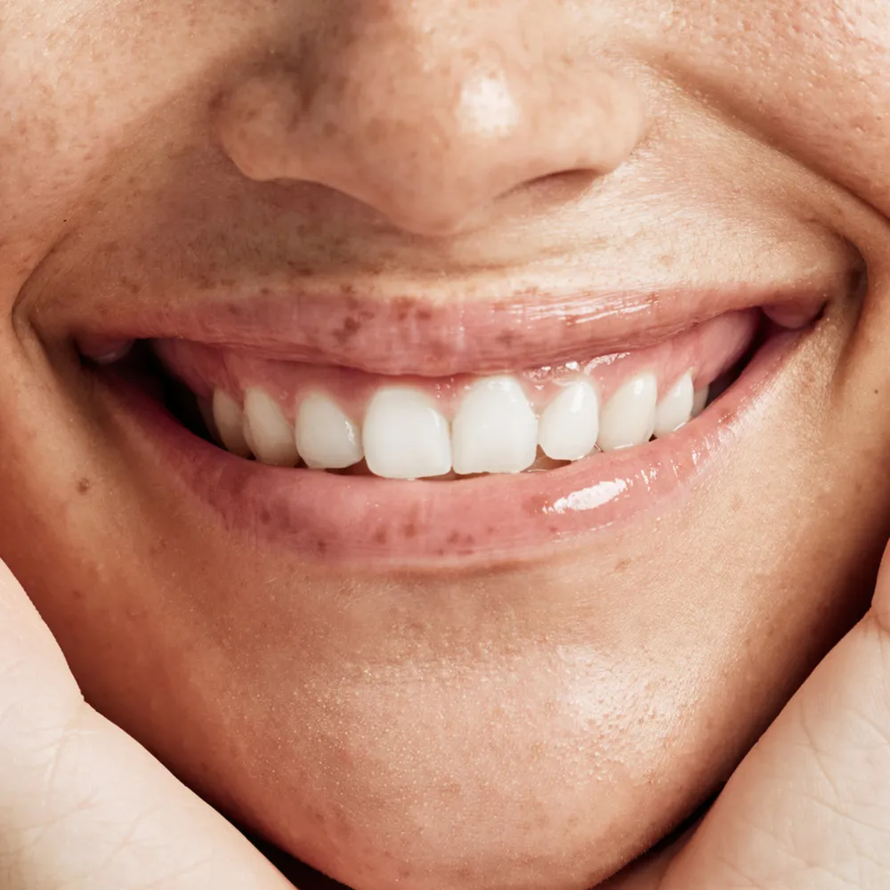 Laser Lip Bleaching London – Lip Pigmentation Treatment