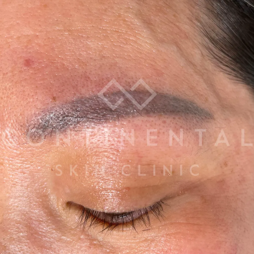 eyebrow hair growth after tattoo removal london