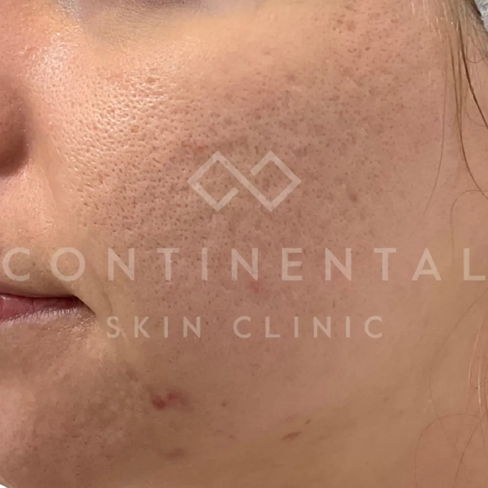 uvelook Volume (Lenisna) PDLLA collagen stimulation treatment for lifting and restoring mild facial volume at a London aesthetic clinic.