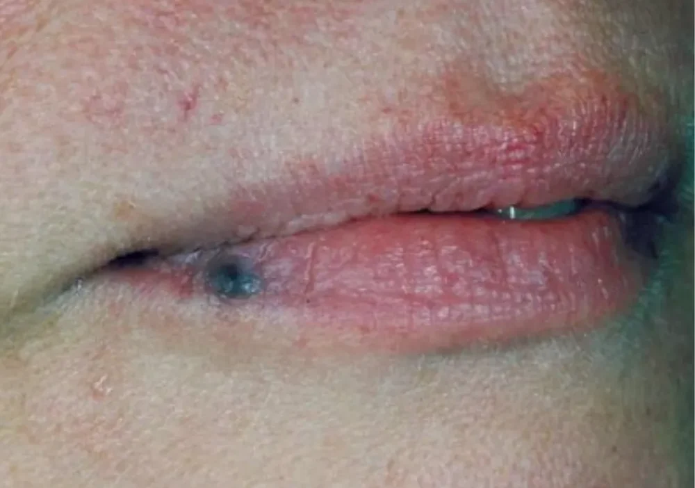 Bluish purple lips caused by vascularity before treatment.