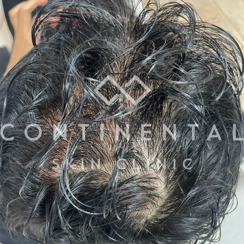 ASCEplus HRLV Hair Regeneration Therapy London