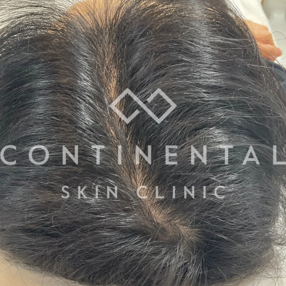 ASCEplus HRLV Hair Regeneration Therapy London