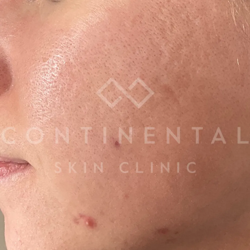 Juvelook provides subtle tightening, hydration and prevention of early ageing by stimulating collagen in a natural, non-volumising way.