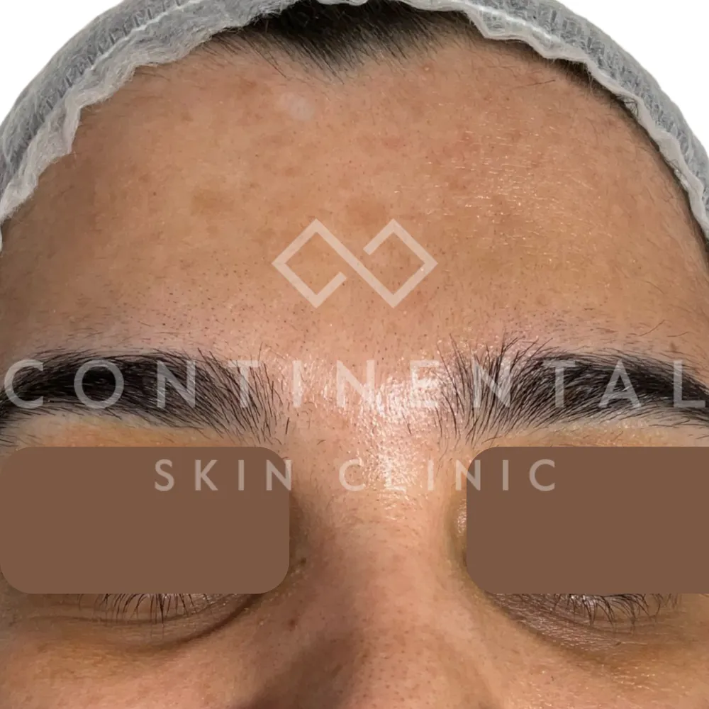 hand brightening treatment london peptide skin booster for hands and knuckles