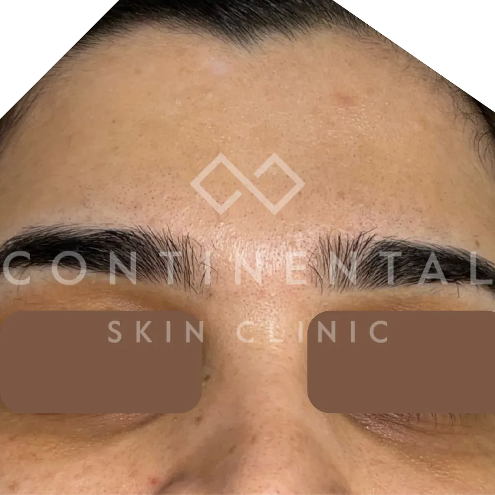 underarm brightening treatment london skin booster for body pigmentation