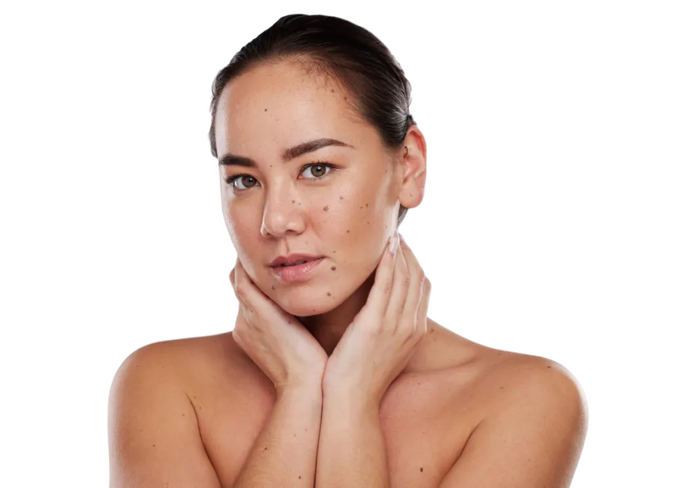 CryoPen cryotherapy effectively removing vascular lesions such as cherry angiomas with precision at Continental Skin Clinic London.