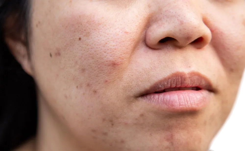 Advanced fractionated laser handpiece delivering controlled micro-beams at multiple skin depths.