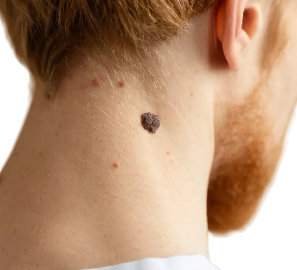 Aesthetic practitioner performing cauterisation lesion removal in London.