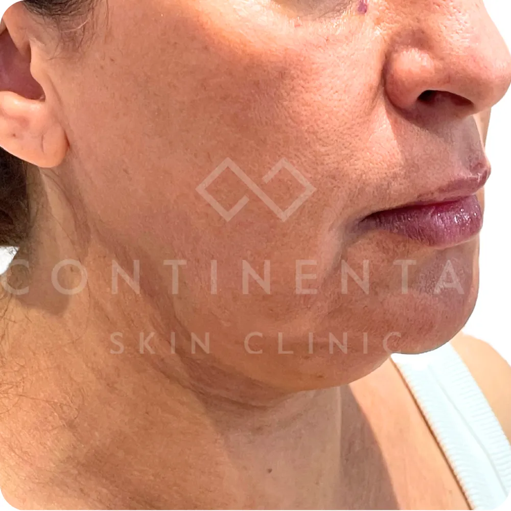 Jawline contouring with Aqualyx fat dissolving in London