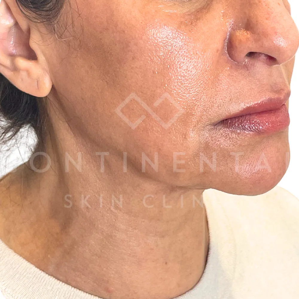 Aqualyx double chin fat dissolving treatment in London