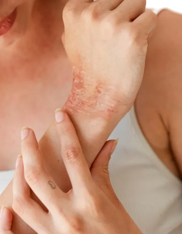 Experience the power of Healite II near-infrared light therapy in London — relaxing, touch-free treatment for radiant, glowing skin. Psoriasis, Dermatitis, Eczema