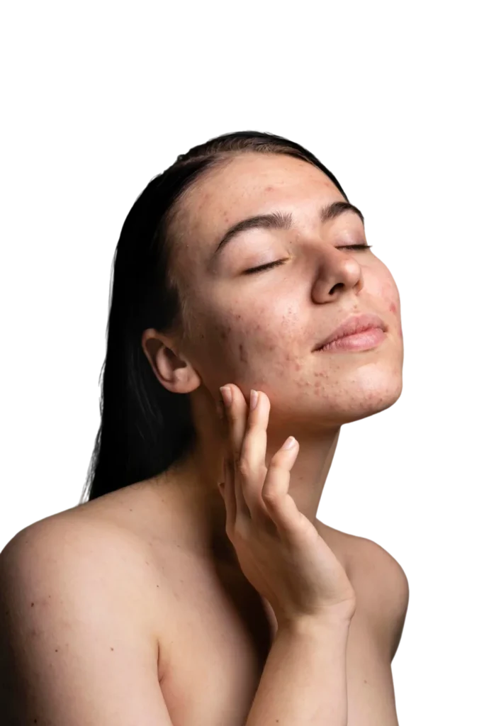 Acne management treatment plan for breakouts and congestion
