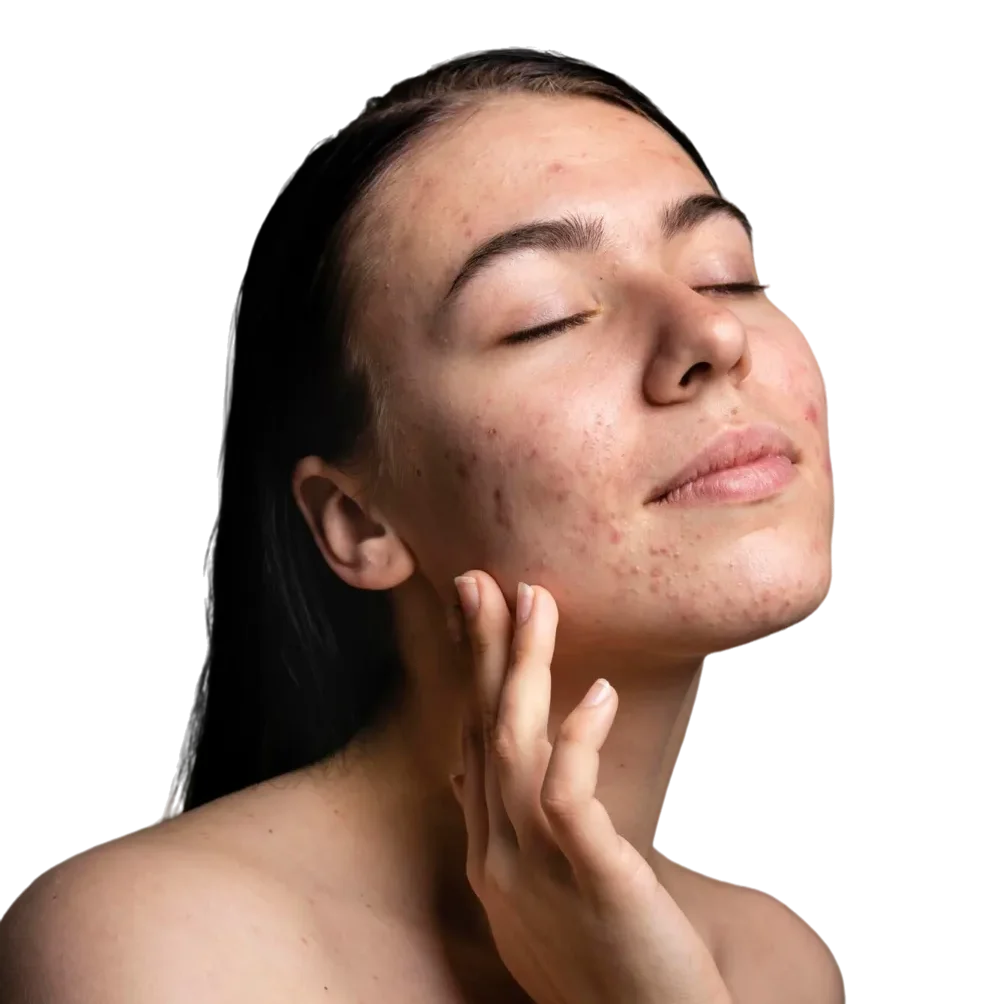 Hollywood Spectra’s gentle Q-switched laser helps calm redness and strengthen capillaries, improving overall tone for rosacea-prone skin.