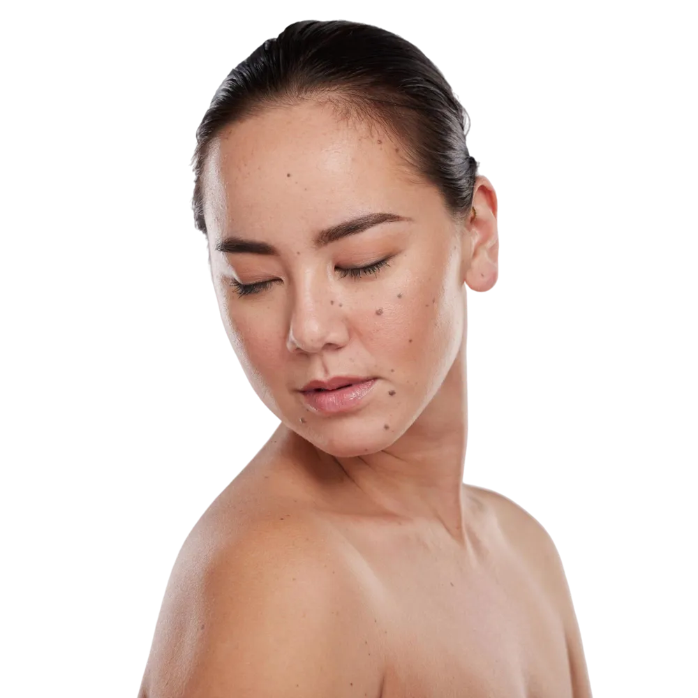 CryoPen freezing a skin tag with targeted nitrous oxide