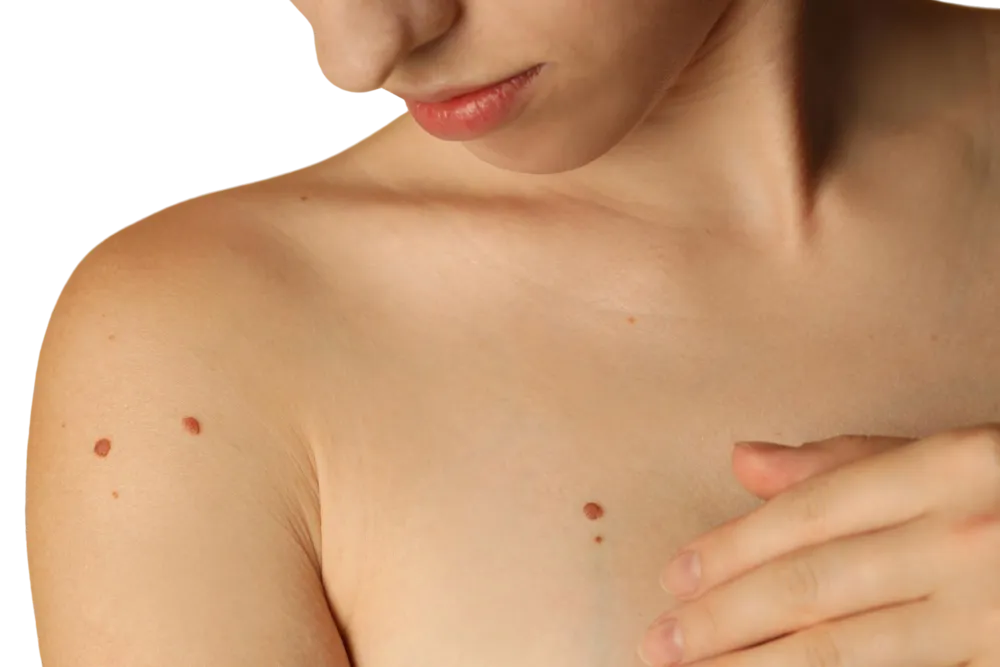 Safe, precise lesion removal in London using CryoPen & cauterisation. Remove skin tags, warts & benign growths with minimal downtime and natural results.