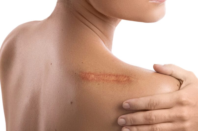 Soothing and pain-free Healite II LED Light Therapy session — restoring healthy skin tone and natural luminosity with zero downtime.