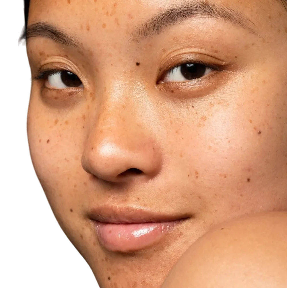 Targeting freckles and sunspots with RuVY Touch — advanced 660 nm laser for precise pigment removal.