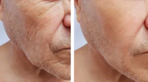 exosomes skin boosters. cosmetic injections