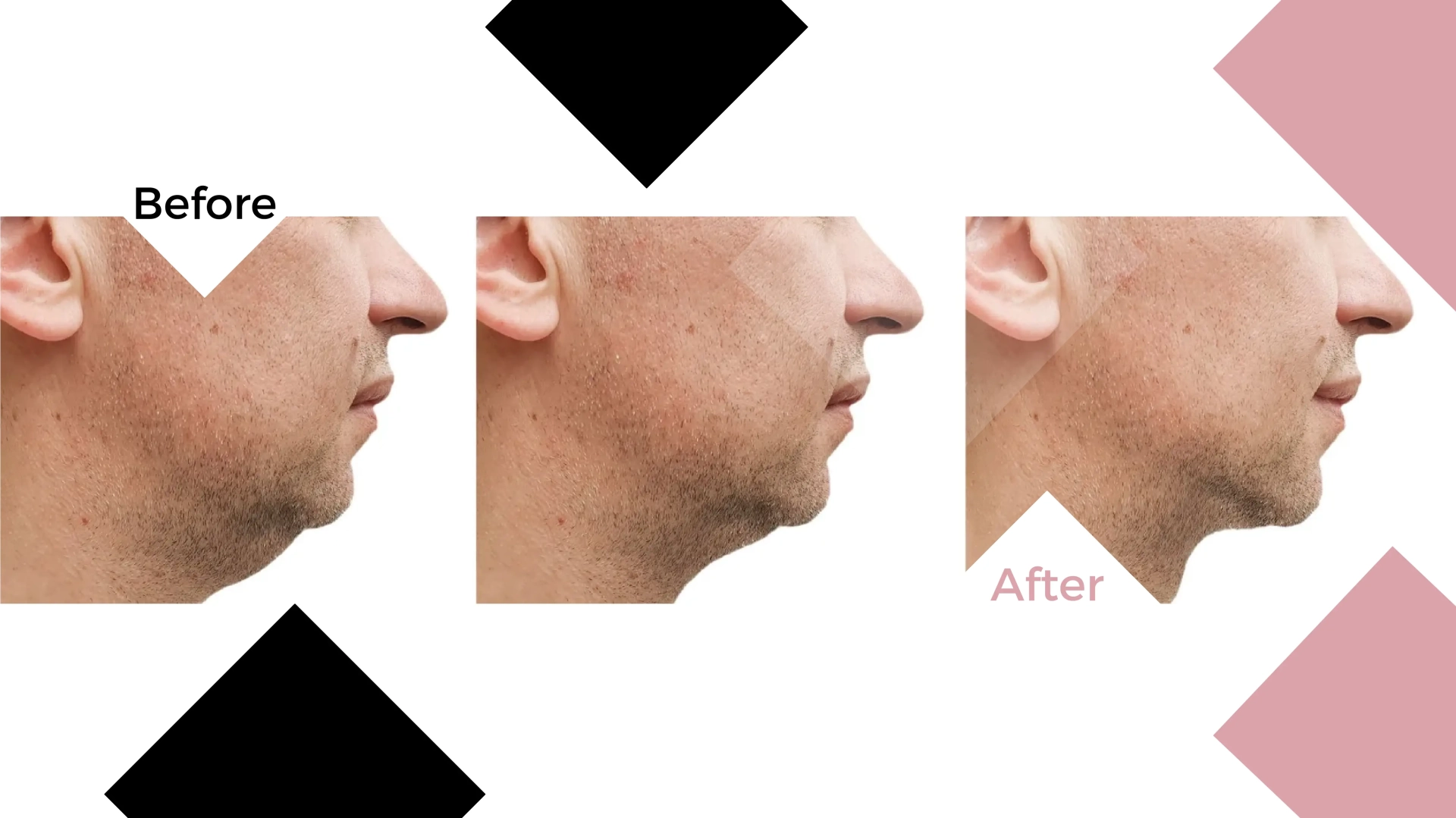 Fat dissolving injections before and after