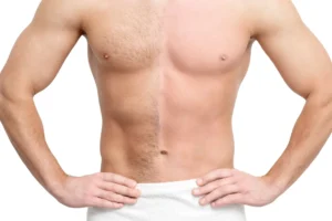laser hair removal london. laser hair removal skin clinic. 