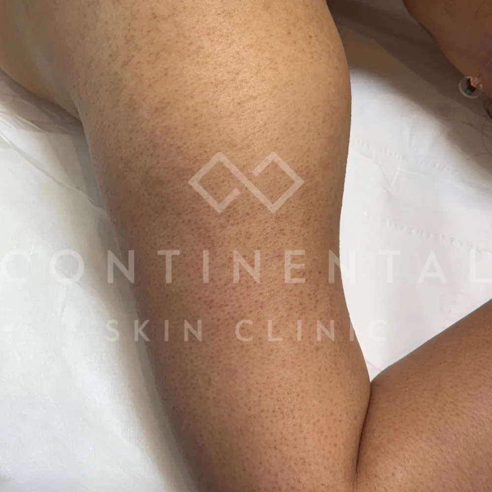 nordlys swt ipl vascular lesion treatment london nose cheeks