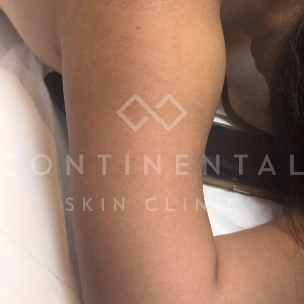 nordlys swt ipl keratosis pilaris treatment london