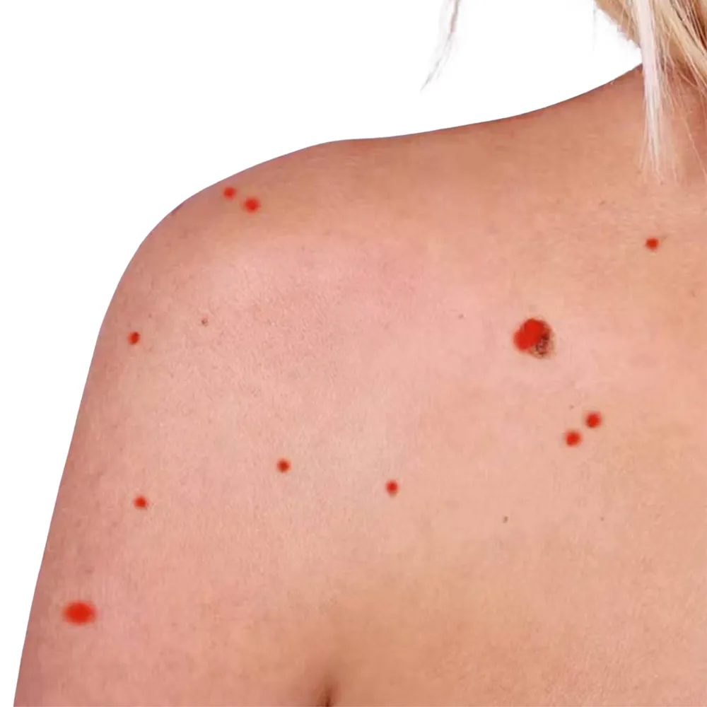 nordlys swt ipl cherry angioma removal london