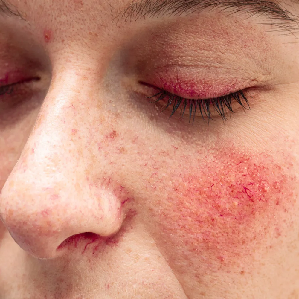 nordlys swt ipl broken capillaries treatment london