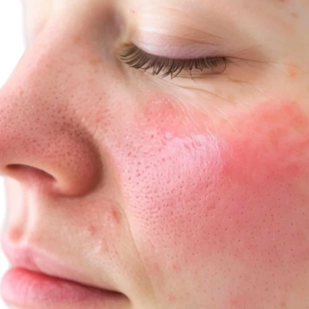 nordlys swt ipl rosacea treatment london