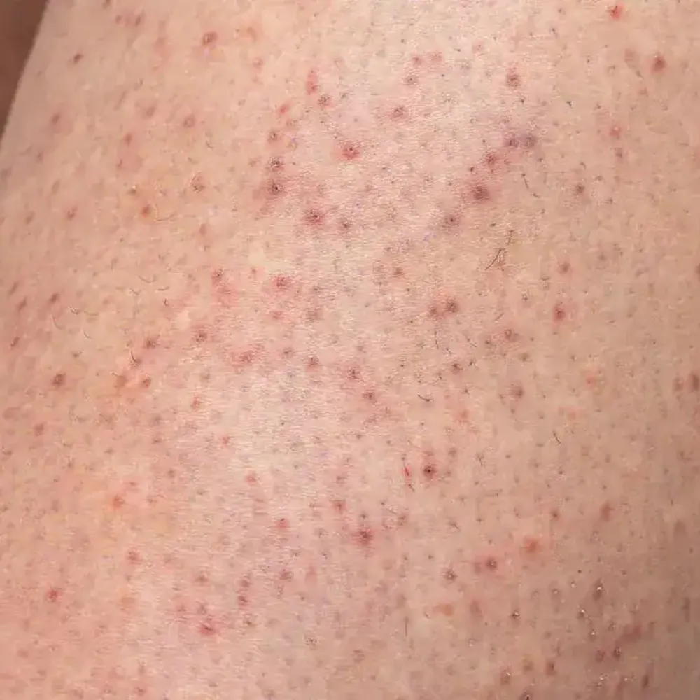 nordlys swt ipl keratosis pilaris treatment london
