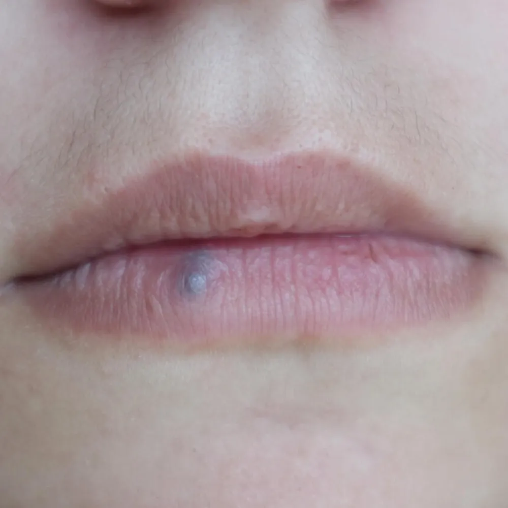 nordlys swt ipl venous lake treatment lips london