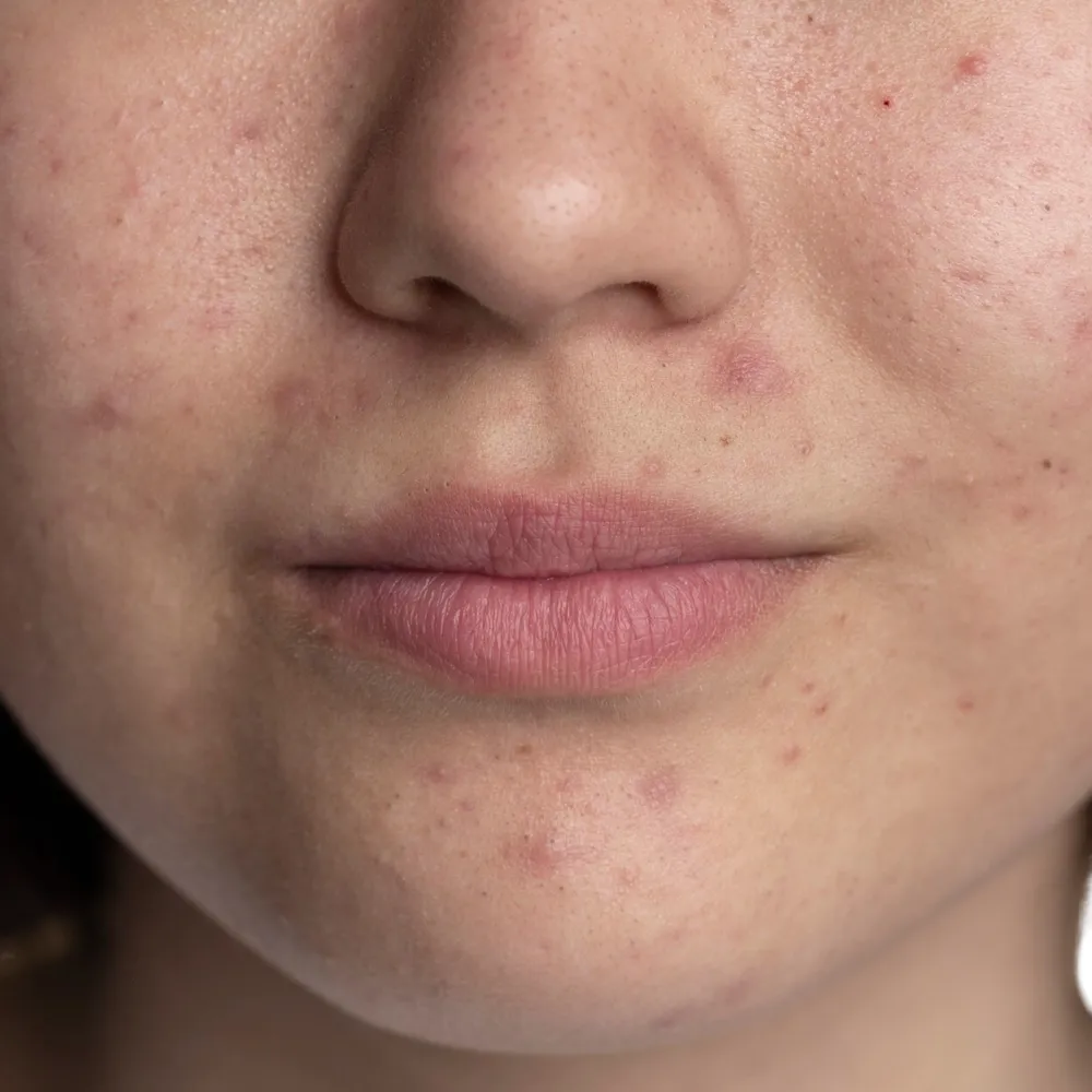 nordlys swt ipl oily skin treatment sebum reduction london