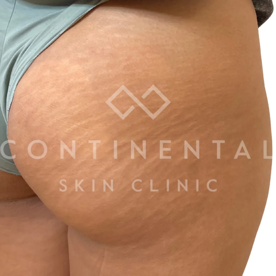 Muna Alghalib b&a 1x infini 1x peel (1)