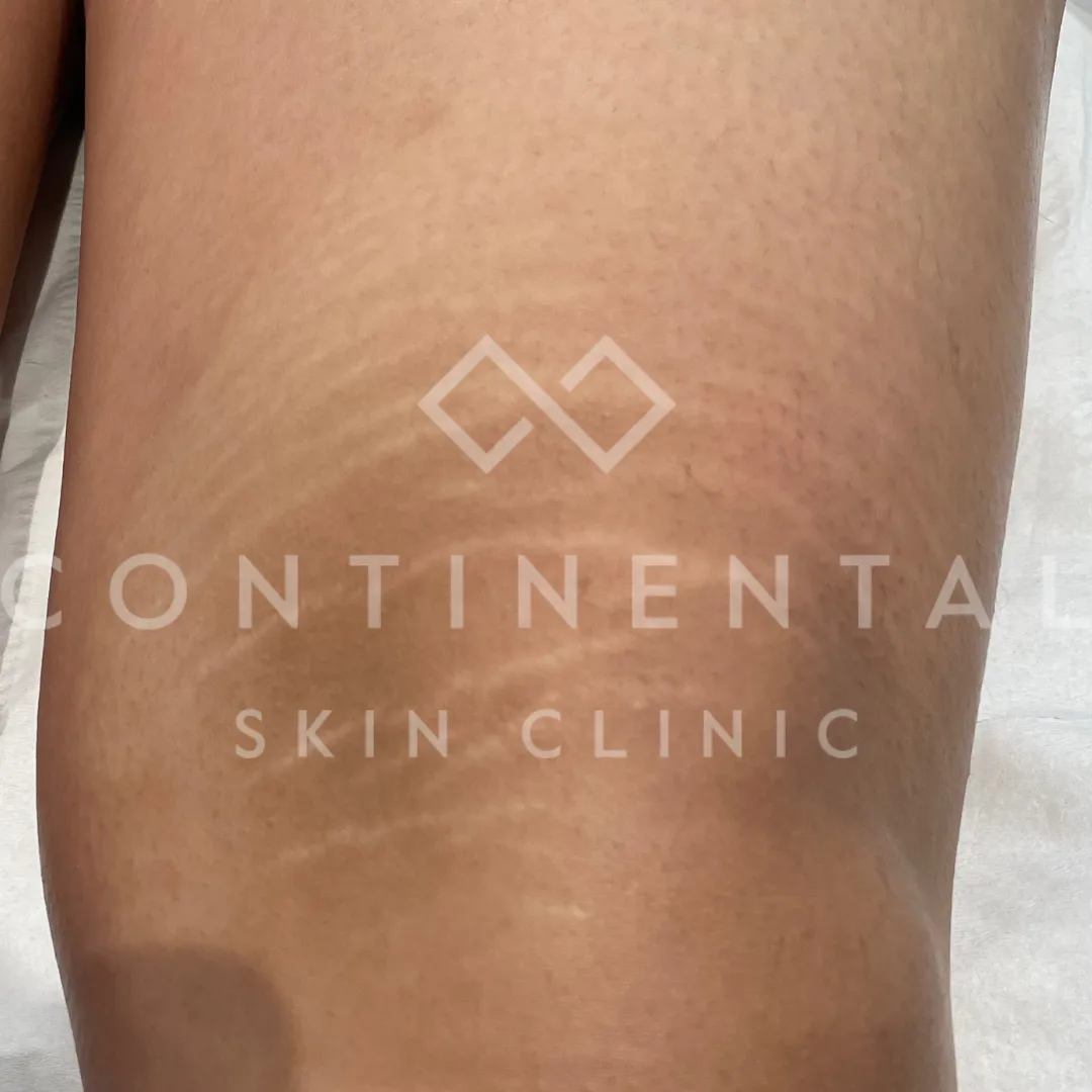 Muna Alghalib b&a 1x infini 1x peel (2)