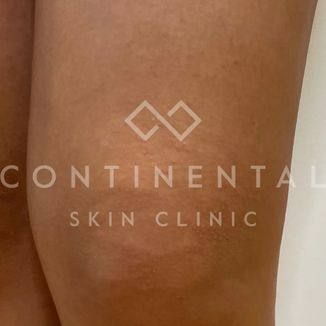 Muna Alghalib b&a 1x infini 1x peel (3)