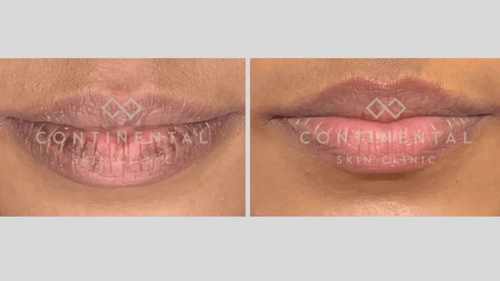 can glutathione lighten dark lips Lip Pigmentation Treatment