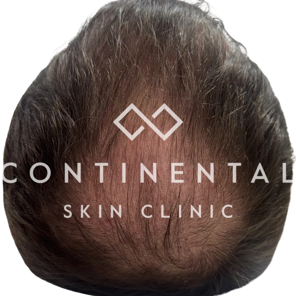 After image showing improvement in male androgenetic alopecia at the crown following ASCE+ HRLV exosomes via Ultra LaseMD