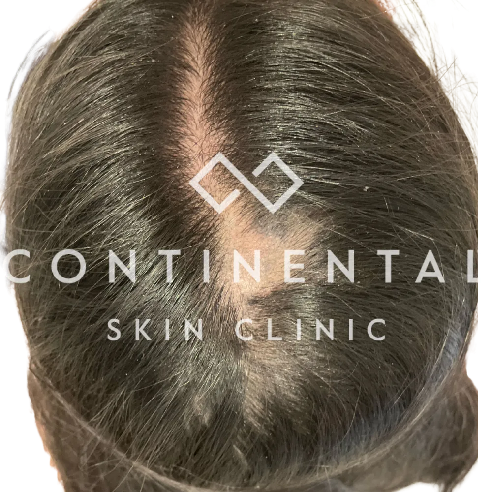 Before image of female alopecia prior to treatment with ASCE+ HRLV exosomes delivered via Ultra LaseMD