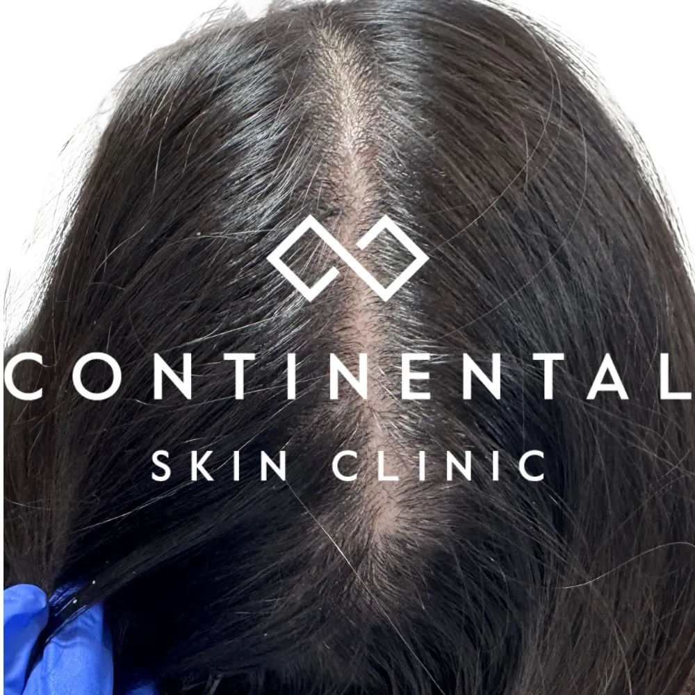 After image showing improvement in female alopecia following ASCE+ HRLV exosomes delivered via Ultra LaseMD